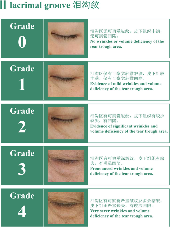 中國女性淚溝紋分級標準-上海市皮膚病醫(yī)院
